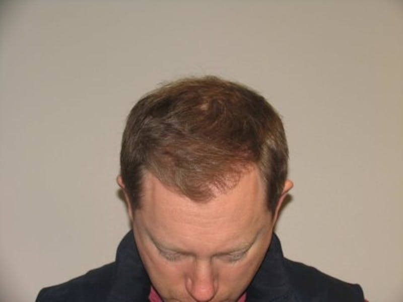 NeoGraft For Men Before & After Gallery - Patient 418228 - Image 1