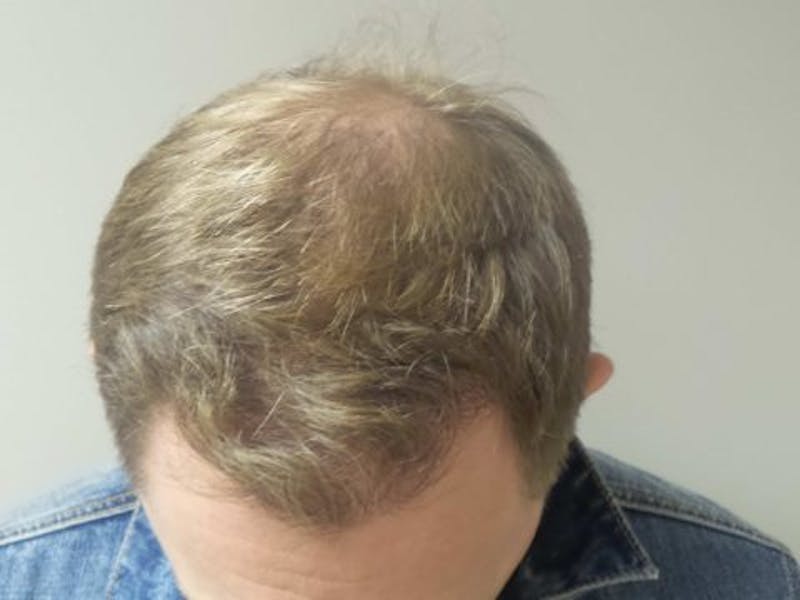 NeoGraft For Men Before & After Gallery - Patient 418228 - Image 2