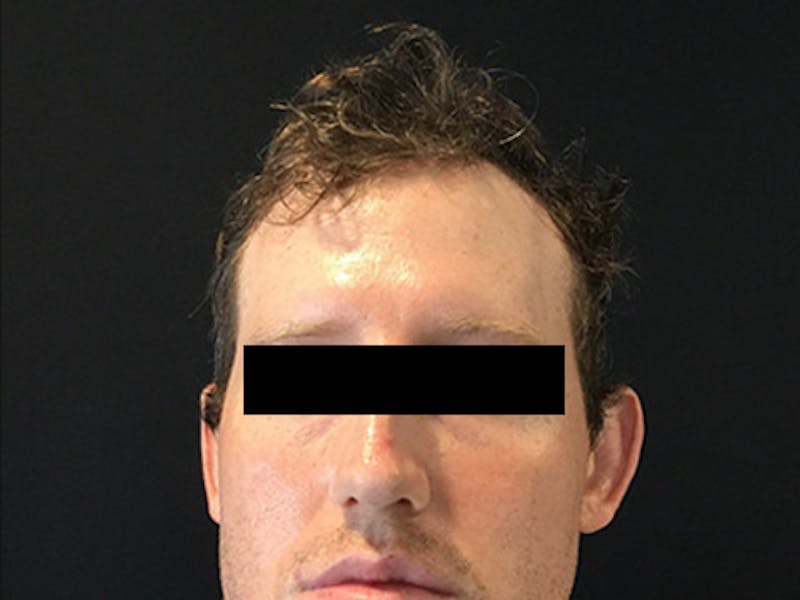 NeoGraft For Men Before & After Gallery - Patient 405708 - Image 1
