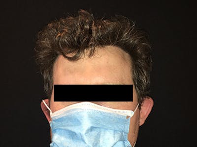 NeoGraft For Men Before & After Gallery - Patient 405708 - Image 2
