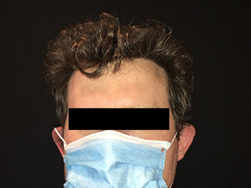 NeoGraft For Men Before & After Gallery - Patient 405708 - Image 2