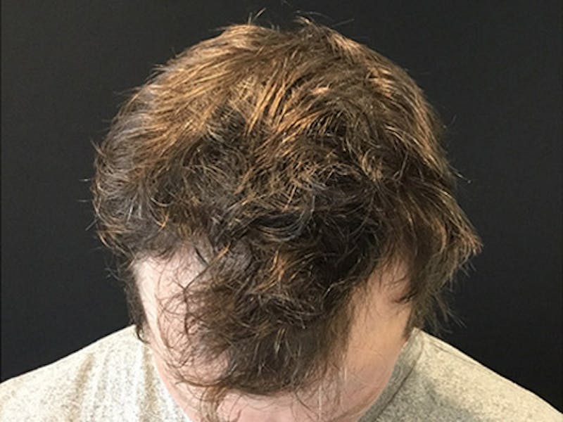 NeoGraft For Men Before & After Gallery - Patient 405708 - Image 3