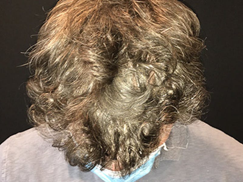 NeoGraft For Men Before & After Gallery - Patient 405708 - Image 4