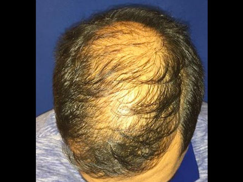 NeoGraft For Men Before & After Gallery - Patient 122356 - Image 1