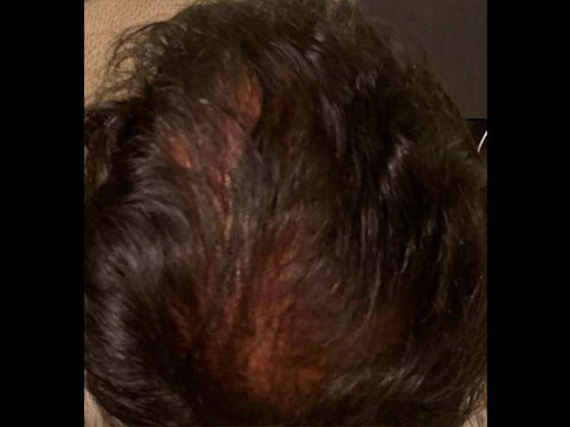 NeoGraft For Men Before & After Gallery - Patient 122356 - Image 2