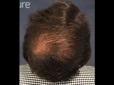 NeoGraft For Men Before & After Gallery - Patient 111451 - Image 1