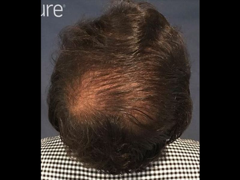 NeoGraft For Men Before & After Gallery - Patient 111451 - Image 1