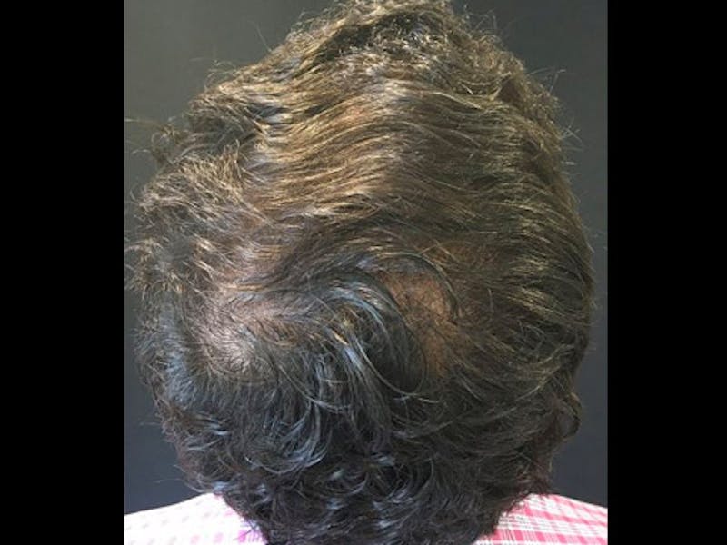 NeoGraft For Men Before & After Gallery - Patient 111451 - Image 2