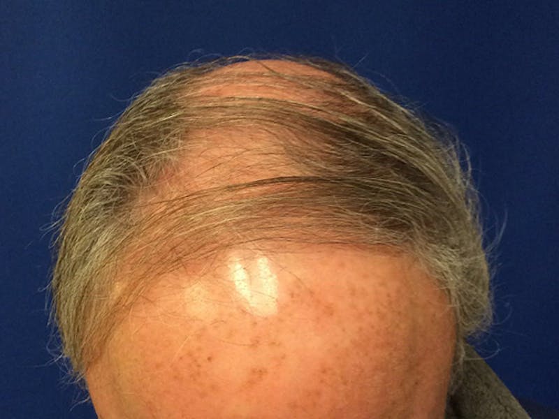 NeoGraft For Men Before & After Gallery - Patient 143630 - Image 1