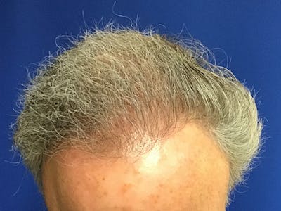 NeoGraft For Men Before & After Gallery - Patient 143630 - Image 2
