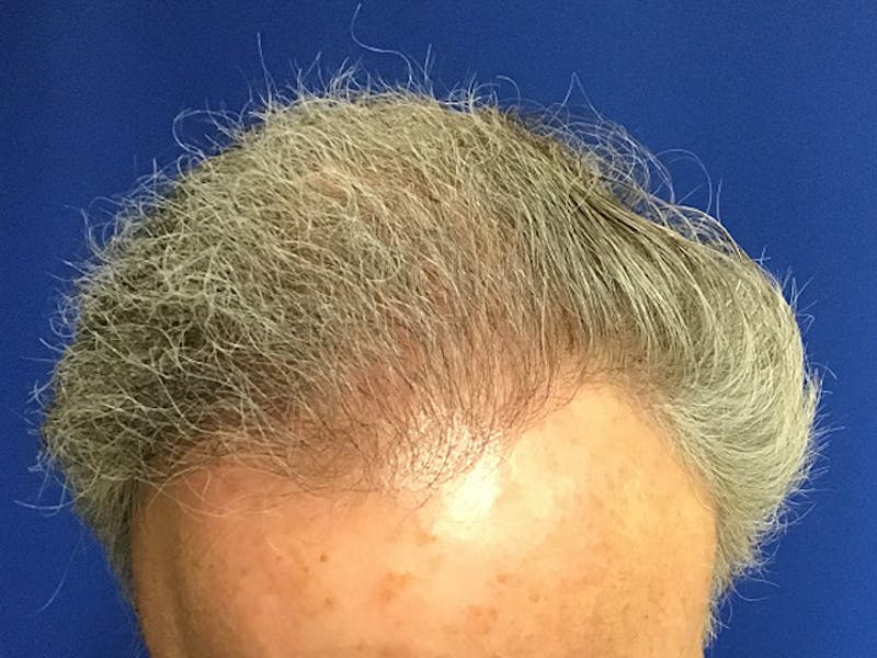 NeoGraft For Men Before & After Gallery - Patient 143630 - Image 2