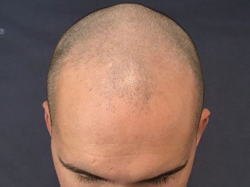 NeoGraft For Men Before & After Gallery - Patient 357496 - Image 1