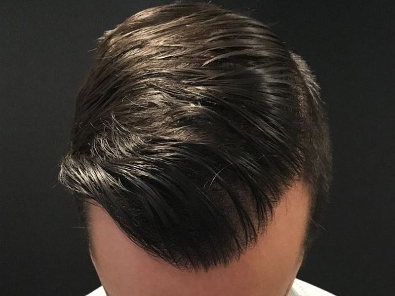 NeoGraft For Men Before & After Gallery - Patient 357496 - Image 2