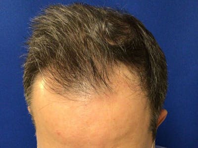 NeoGraft For Men Before & After Gallery - Patient 366372 - Image 1