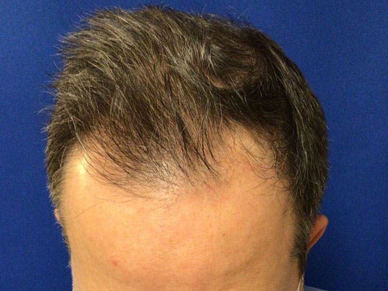NeoGraft For Men Before & After Gallery - Patient 366372 - Image 1