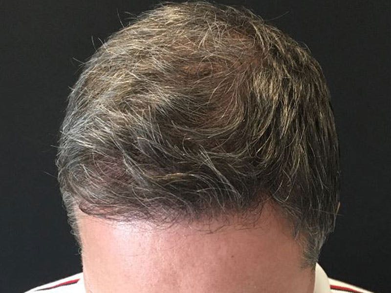 NeoGraft For Men Before & After Gallery - Patient 366372 - Image 2