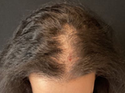 Neograft Before & After Gallery - Patient 404303 - Image 1