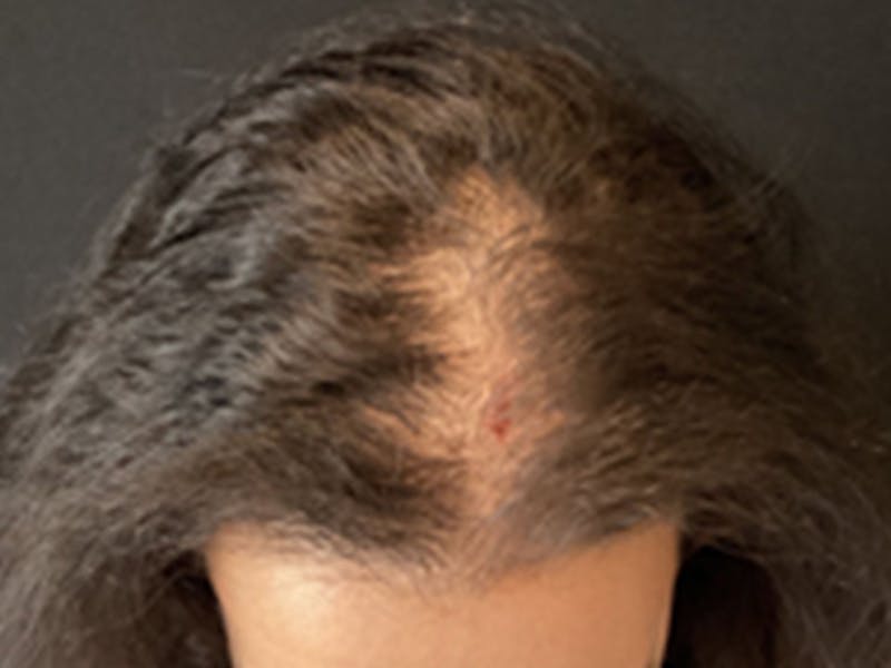 Neograft Before & After Gallery - Patient 404303 - Image 1