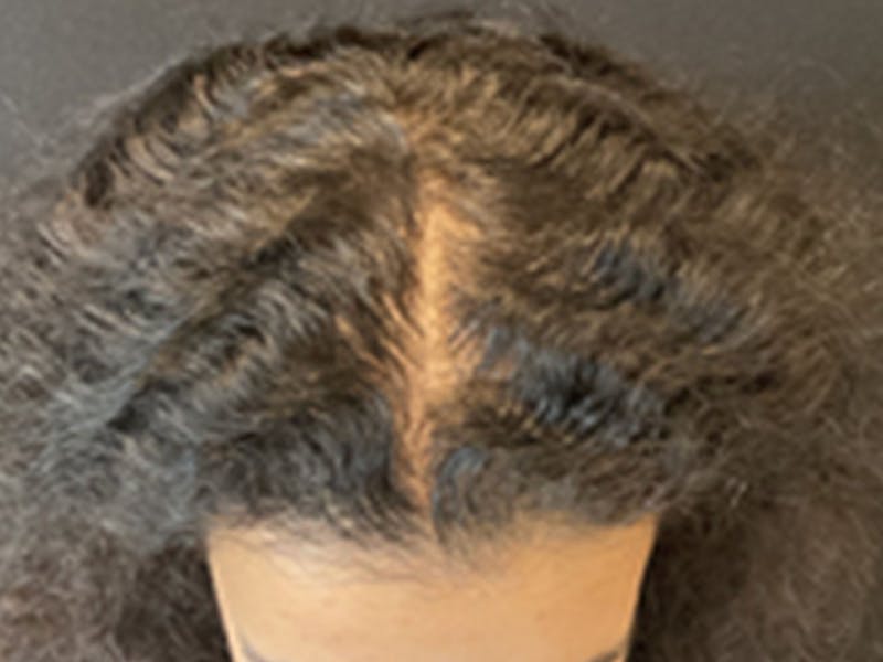 Neograft Before & After Gallery - Patient 404303 - Image 2