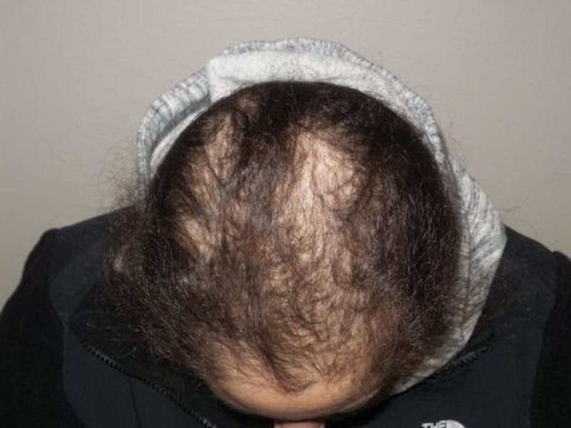 Neograft Before & After Gallery - Patient 309284 - Image 1