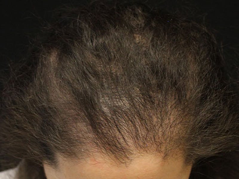 Neograft Before & After Gallery - Patient 309284 - Image 2