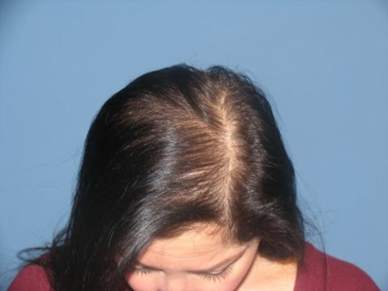 Neograft Before & After Gallery - Patient 192516 - Image 1