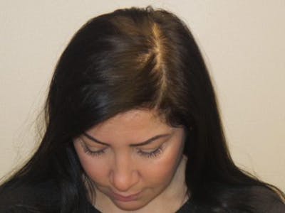 Neograft Before & After Gallery - Patient 192516 - Image 2