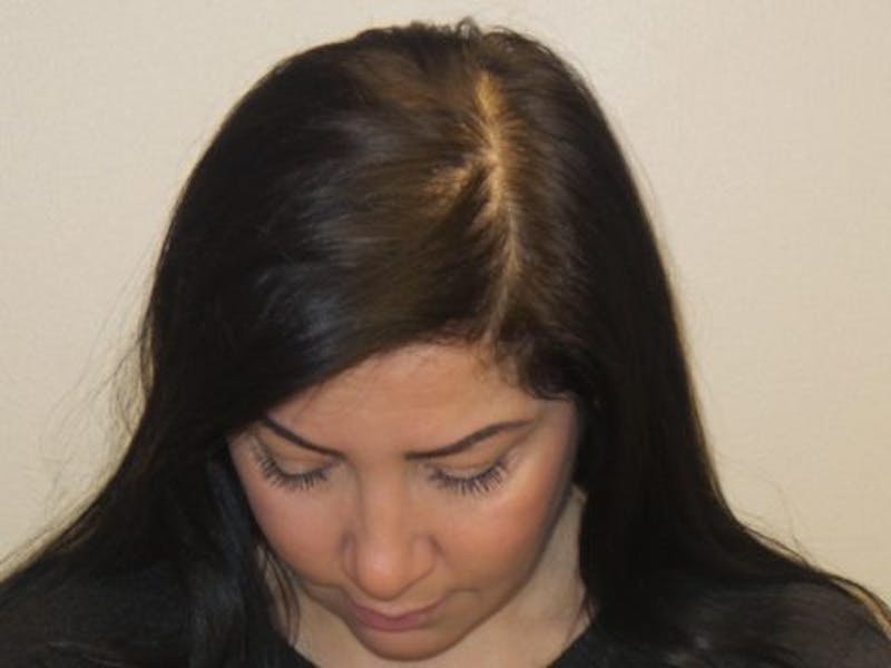 Neograft Before & After Gallery - Patient 192516 - Image 2