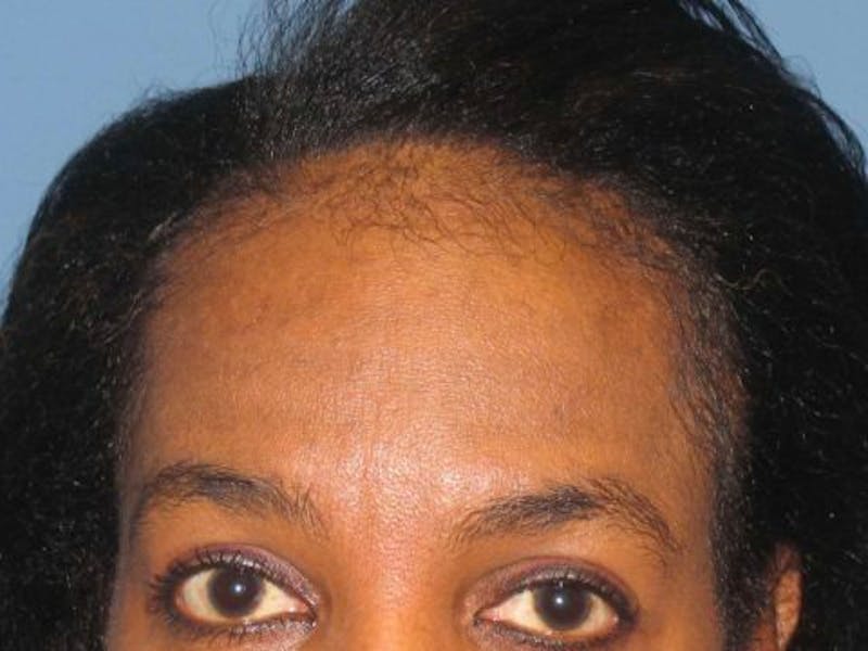 Neograft Before & After Gallery - Patient 287314 - Image 1