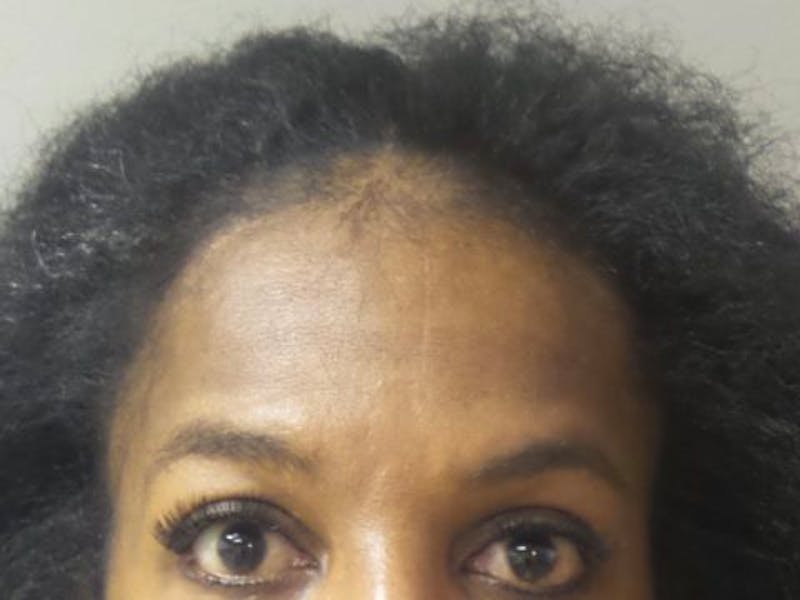 Neograft Before & After Gallery - Patient 287314 - Image 2
