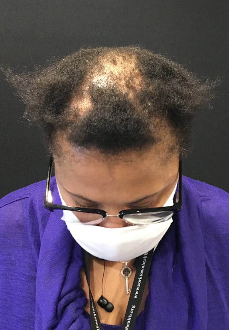 Neograft Before & After Gallery - Patient 209511 - Image 1