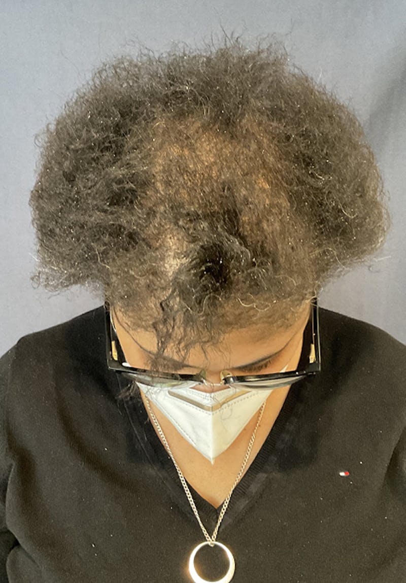 Neograft Before & After Gallery - Patient 209511 - Image 2