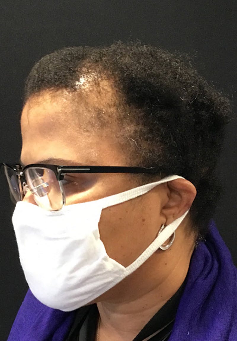 Neograft Before & After Gallery - Patient 209511 - Image 3