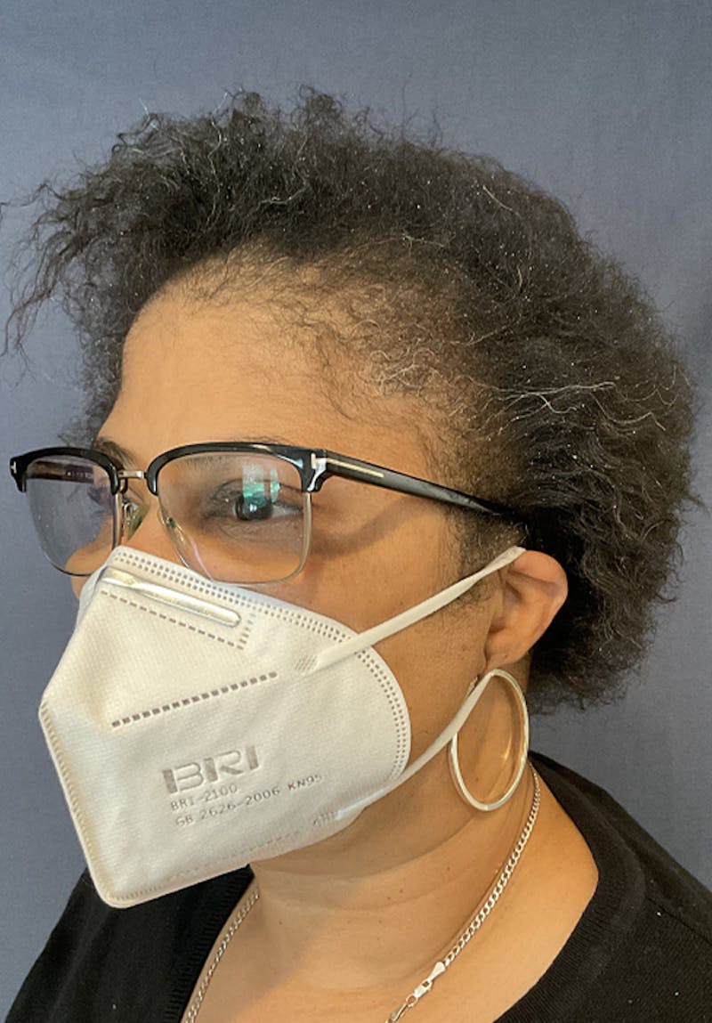 Neograft Before & After Gallery - Patient 209511 - Image 4