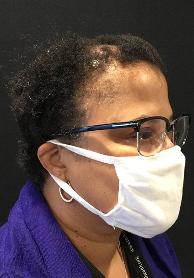 Neograft Before & After Gallery - Patient 209511 - Image 5