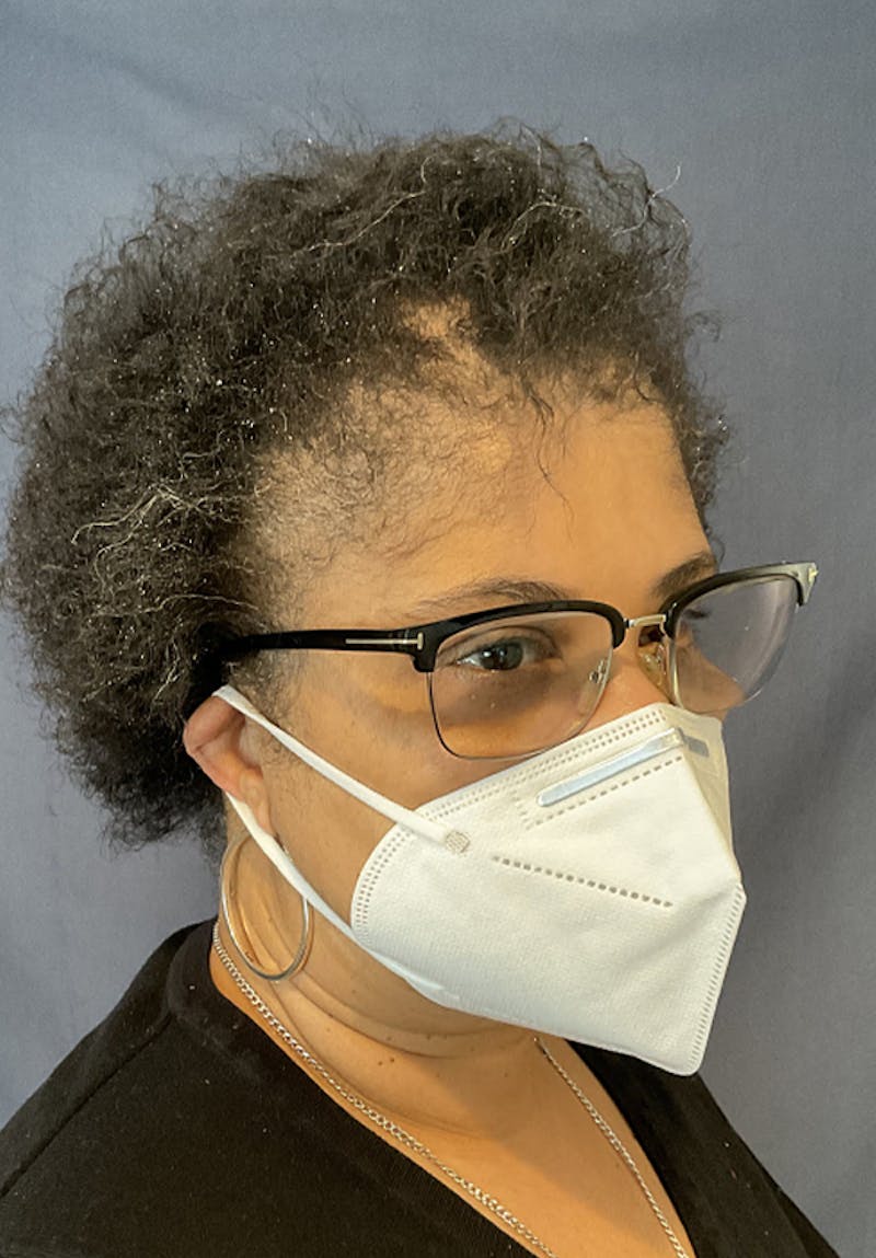 Neograft Before & After Gallery - Patient 209511 - Image 6