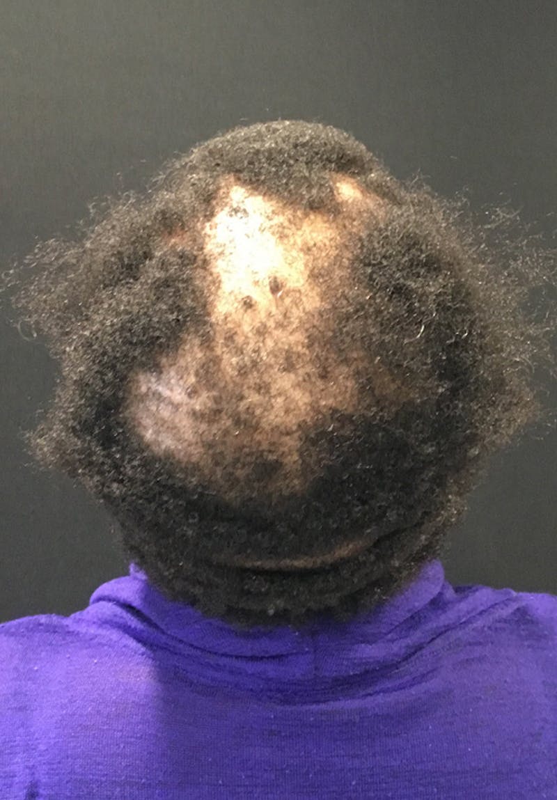 Neograft Before & After Gallery - Patient 209511 - Image 7