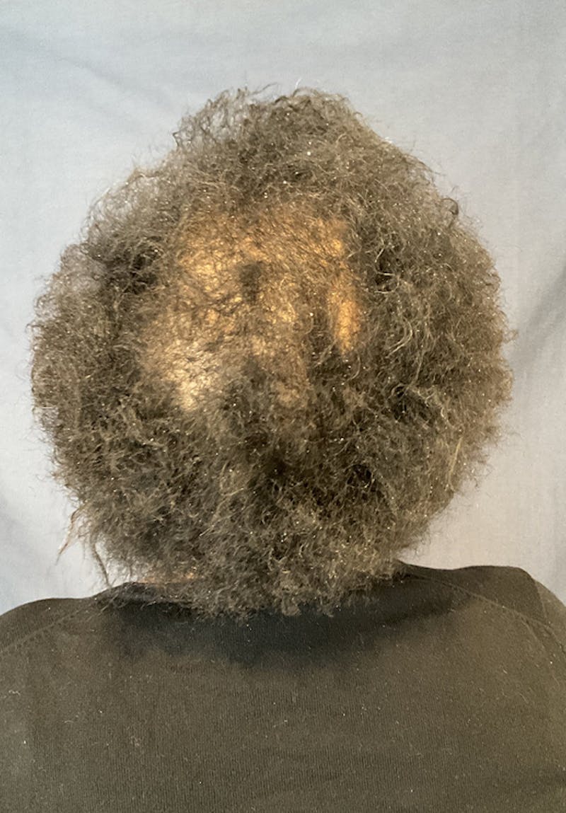 Neograft Before & After Gallery - Patient 209511 - Image 8