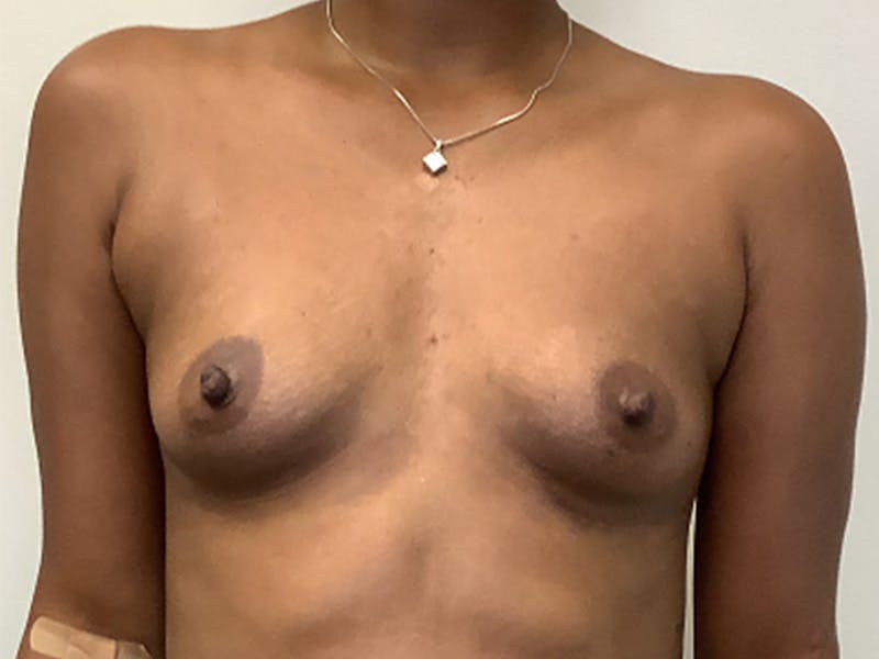 Breast Augmentation Before & After Gallery - Patient 144248 - Image 1