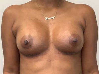 Breast Augmentation Before & After Gallery - Patient 144248 - Image 2
