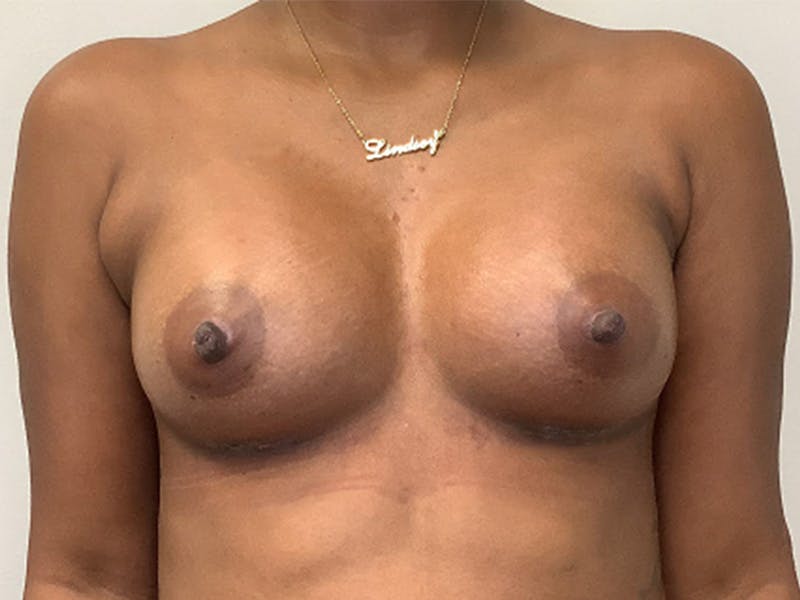 Breast Augmentation Before & After Gallery - Patient 144248 - Image 2