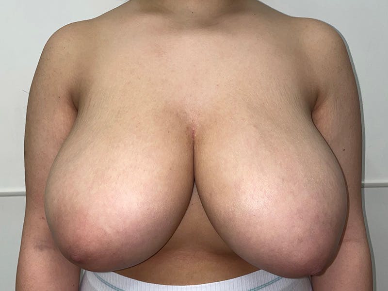 Breast Reduction With Lift Before & After Gallery - Patient 466557 - Image 1