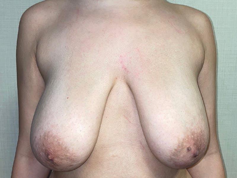 Breast Reduction With Lift Before & After Gallery - Patient 155779 - Image 1