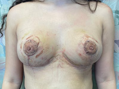 Breast Reduction With Lift Before & After Gallery - Patient 155779 - Image 2