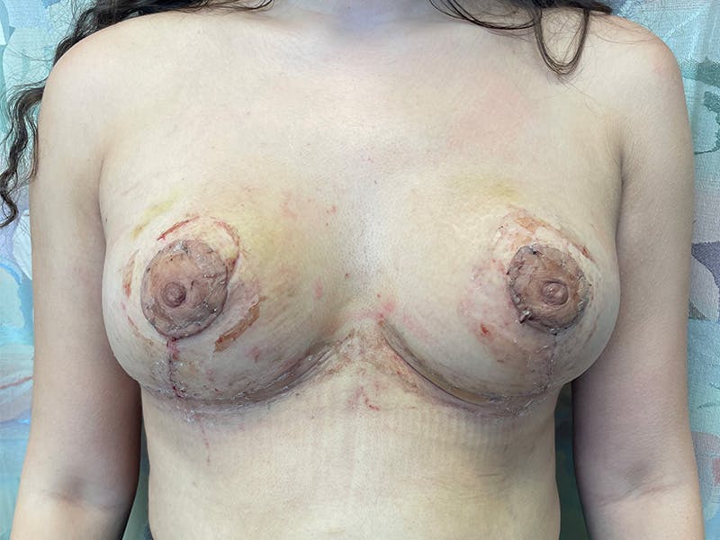 Breast Reduction With Lift Before & After Gallery - Patient 155779 - Image 2