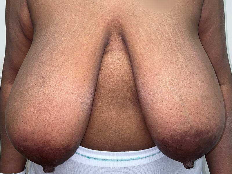 Breast Reduction With Lift Before & After Gallery - Patient 260079 - Image 1