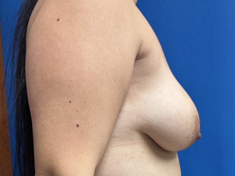 Breast Lift Before & After Gallery - Patient 784780 - Image 3