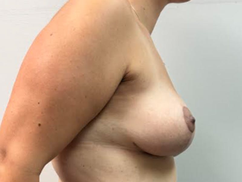 Breast Lift Before & After Gallery - Patient 784780 - Image 4