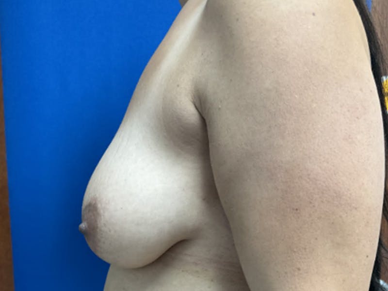 Breast Lift Before & After Gallery - Patient 784780 - Image 5