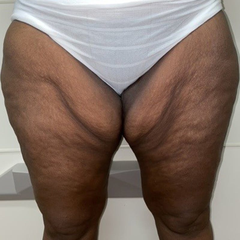 Thigh Lift Before & After Gallery - Patient 283790 - Image 1
